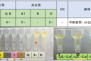 初识1例罕见血型B(A)02/ O01