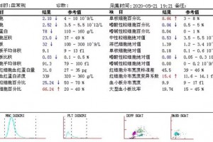 急性早幼粒细胞白血病伴嗜碱性粒细胞增多