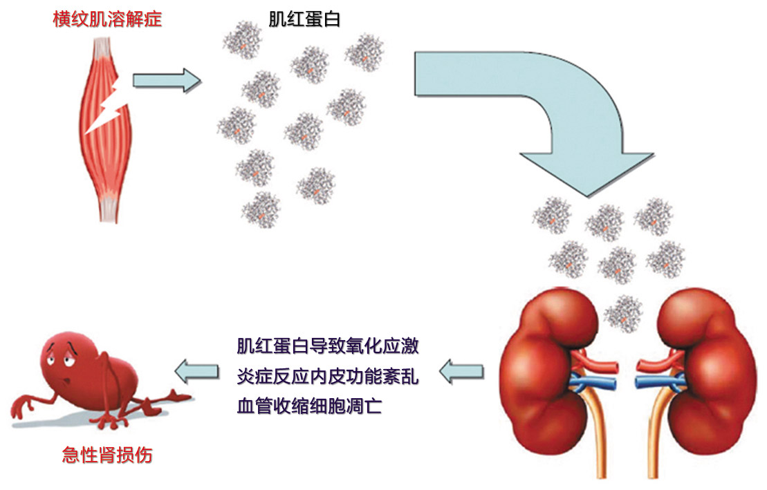 甲状腺功能减退致肌酸激酶升高原因解析