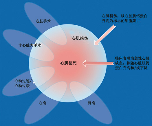 明确高敏心脏肌钙蛋白检测 第99百分位