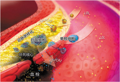 初来乍到的Lp-PLA2