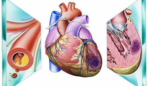 心肌梗死患者实验室检测在临床诊断及治疗效果判断中的意义