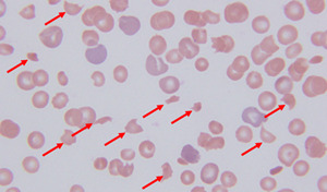 裂片红细胞在Evans综合征和TTP鉴别诊断中的价值与思考