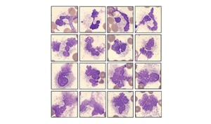 COVID-19感染患者外周血细胞形态学变化