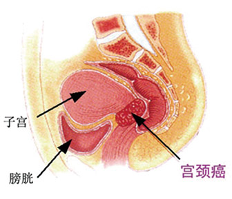 Clinical-Lab_Review_HPV与宫颈癌_V05B-1.jpg