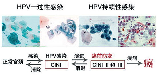 Clinical-Lab_Review_HPV与宫颈癌_V05B-4.jpg