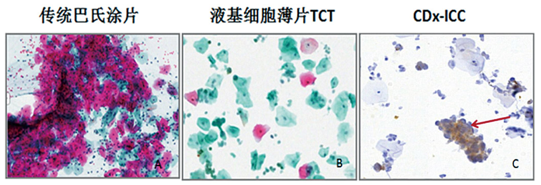 Clinical-Lab_Review_HPV与宫颈癌_V05B-17.jpg