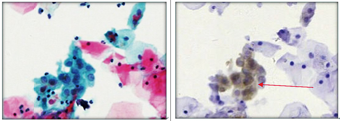 Clinical-Lab_Review_HPV与宫颈癌_V05B-18.jpg