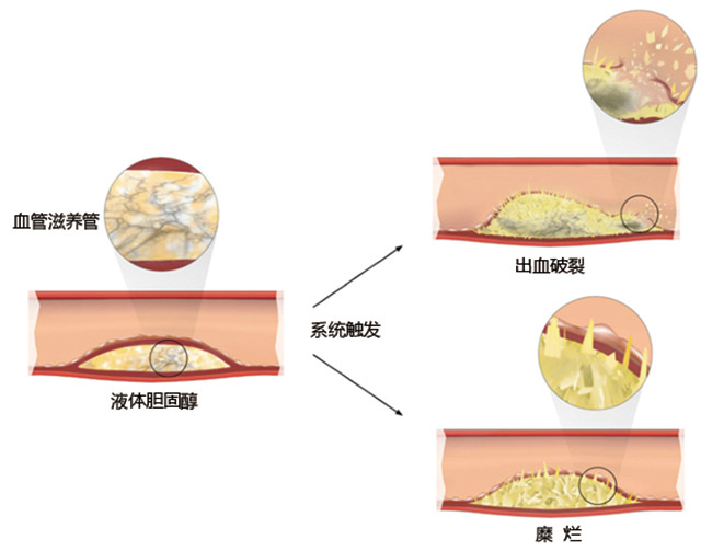 胆固醇结晶-4.jpg