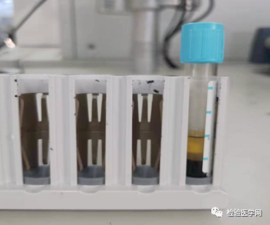 这个D-二聚体不对劲，定有「妖魔」在作怪