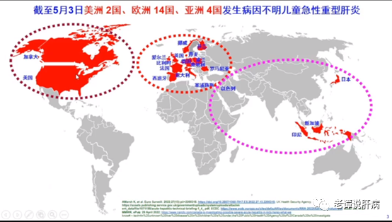 对「儿童不明原因重型肝炎」，我国权威肝病专家的初步共识