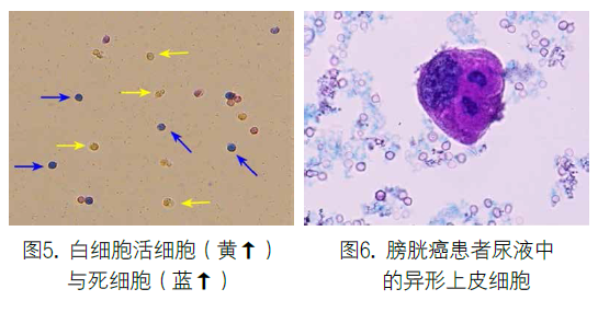 染色法尿液有形成分分析系统的临床应用