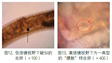 鞭虫感染与检验鉴定一例分析