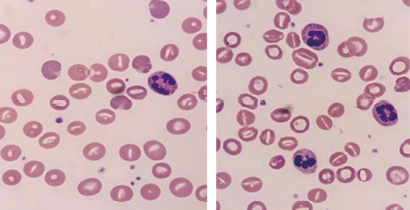 ​遗传性口形红细胞增多症的细胞形态学诊断分析