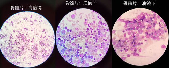 一例铁粒幼细胞明显增多的贫血患者案例