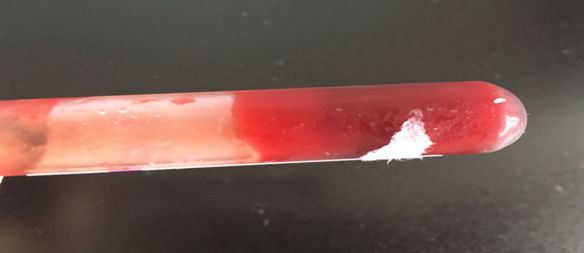 一例不同寻常的血常规标本