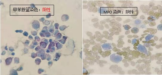 一例少见的非白血病性肥大细胞白血病