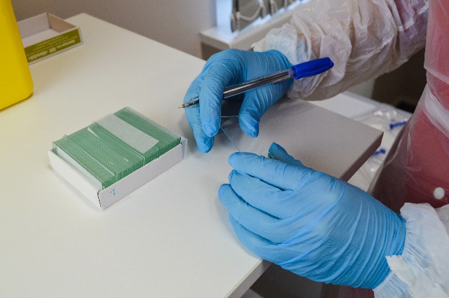 体液细胞形态学涂片在临床工作中的小应用