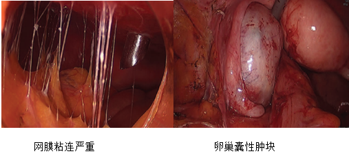 结核性腹膜炎腹部照片图片