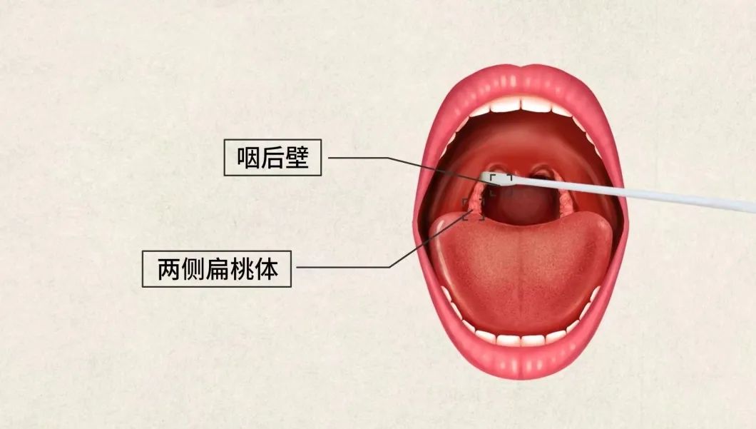 卫健委：咽拭子采集至少擦拭6次，欢迎群众监督举报