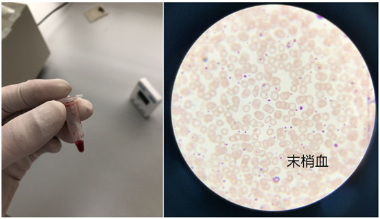 图5,末梢血油镜下再看看静脉血涂片,图6,血小板数量大概在700左右图6