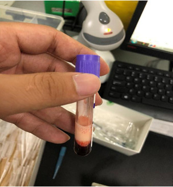 一例重度乳糜血标本,到底是谁在干扰血常规结果?