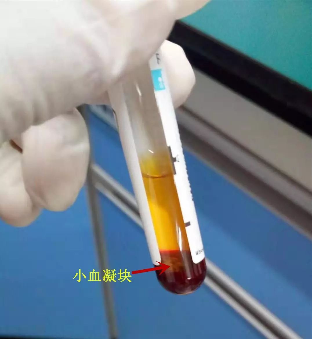 D-二聚体130.7mg/L，静脉血栓栓塞or肺栓塞?_学术交流_检验视界_检验视界网